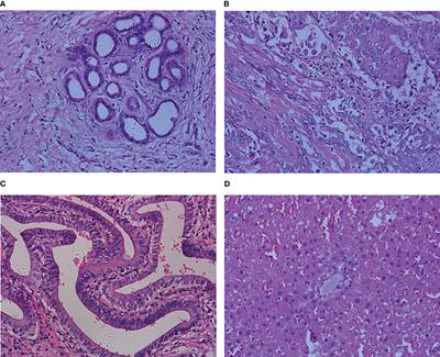 A histopathological image classification method for cholangiocarcinoma based on spatial-channel feature fusion convolution neural network